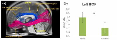 Developmental Differences of Structural Connectivity and Effective Connectivity in Semantic Judgments of Chinese Characters